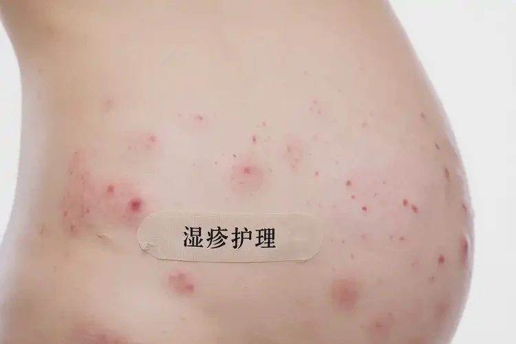 哺乳期媽媽屁股經(jīng)常起濕疹不管它會(huì)自己自愈嗎(圖4)