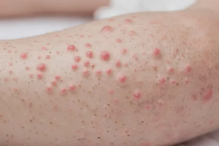 孩子四肢出濕疹可以治好嗎(圖4)