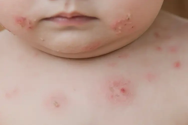 幼兒脖子偶爾起濕疹可以治好嗎(圖4)