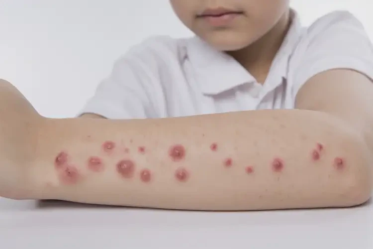 中學(xué)生手臂偶爾長濕疹可以治好嗎(圖4)