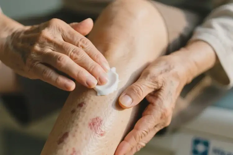 老人小腿偶爾長濕疹可以治好嗎(圖4)