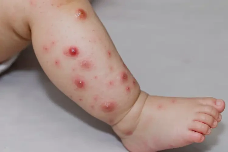 嬰幼兒小腿上出濕疹可以治好嗎(圖3)