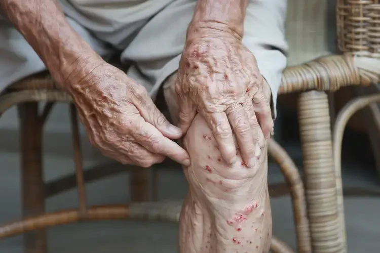 高齡老人小腿上出濕疹可不可以根治(圖4)