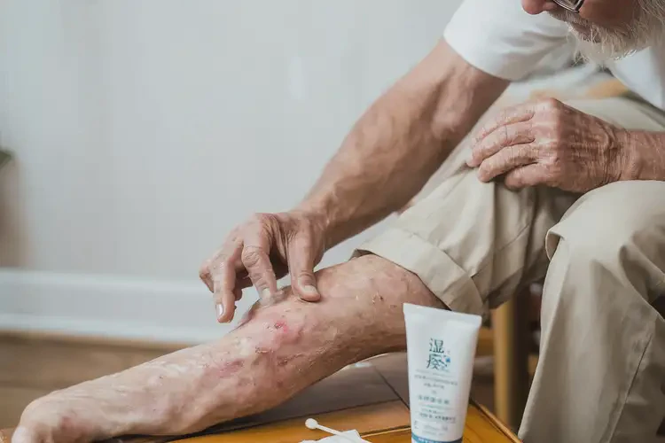 老人小腿经常起湿疹可以治好吗(图2)