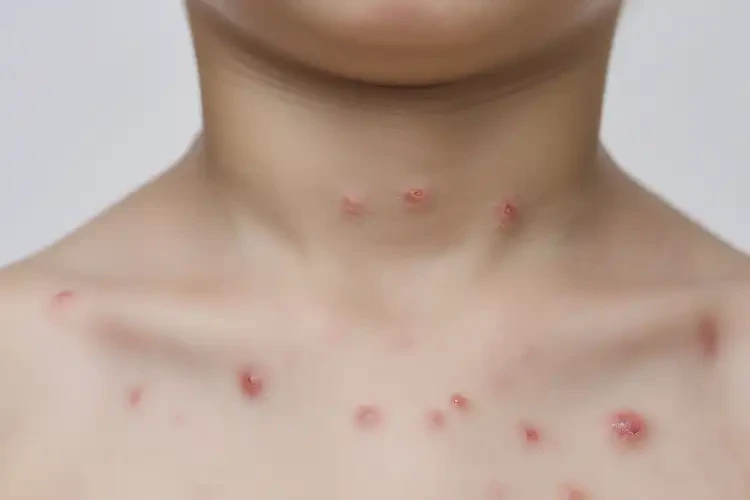 小学生脖子上有湿疹可不可以根治(图4)