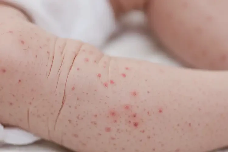 新生兒小腿長濕疹可不可以根治(圖4)