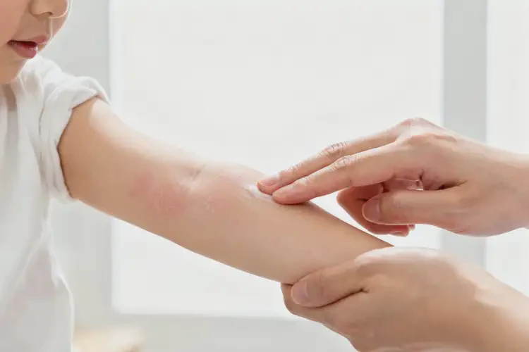 兒童手臂經(jīng)常起濕疹能靠自己自愈嗎(圖2)