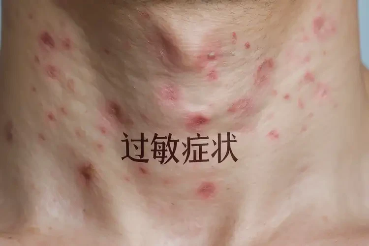 大學(xué)生脖子上偶爾長濕疹可不可以根治(圖4)