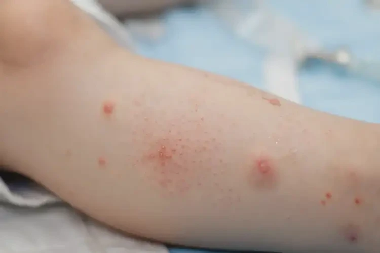 小孩小腿上起濕疹可以治好嗎(圖3)