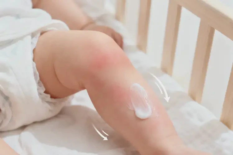 嬰兒小腿上偶爾起濕疹可以治好嗎(圖2)