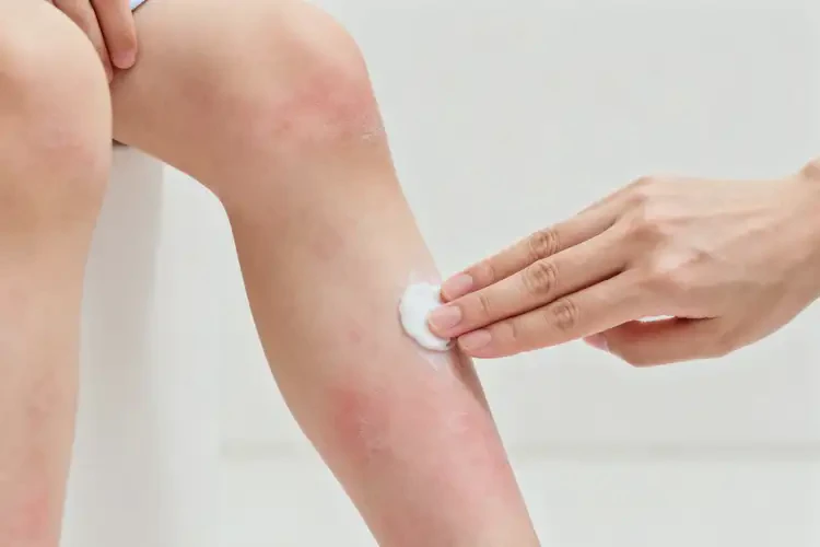 小孩小腿上經(jīng)常長濕疹可以治好嗎(圖2)