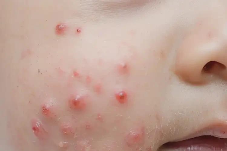 小兒臉上出現(xiàn)濕疹可以治好嗎(圖4)