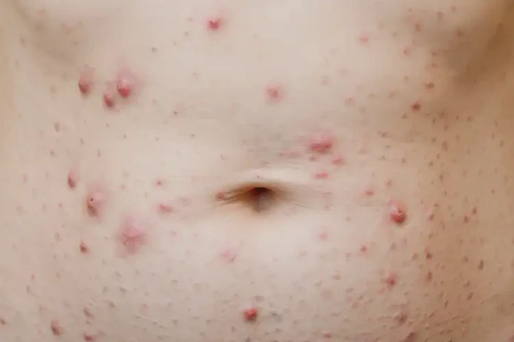 女人肚子經(jīng)常長(zhǎng)濕疹可不可以根治(圖4)