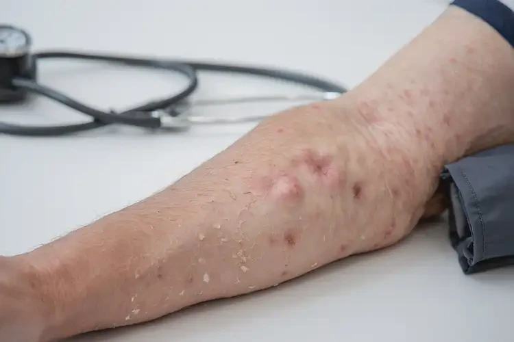 老人手臂上出濕疹可以治好嗎(圖3)