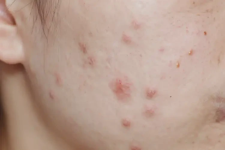 大學(xué)生脖子容易起濕疹可不可以根治(圖4)