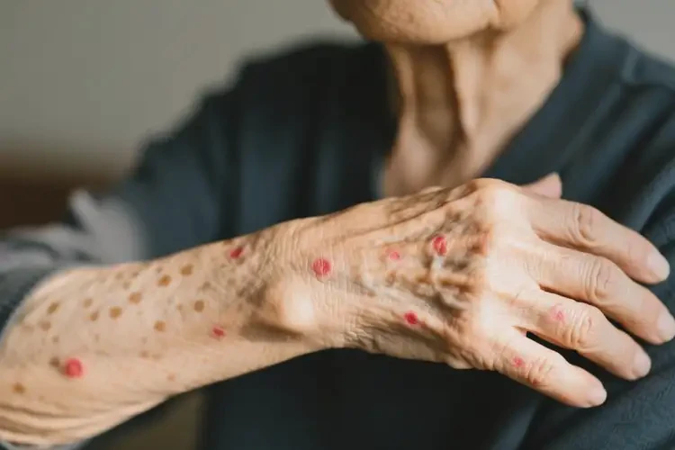 老年人手臂上偶爾長濕疹可以治好嗎(圖4)