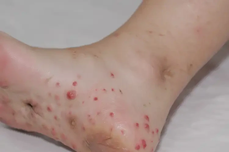 小學(xué)生腳上偶爾長濕疹可不可以根治(圖4)