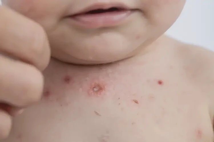 幼兒脖子上容易起濕疹可以治好嗎(圖4)