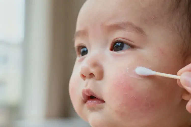 嬰兒臉上偶爾長濕疹可以治好嗎(圖3)