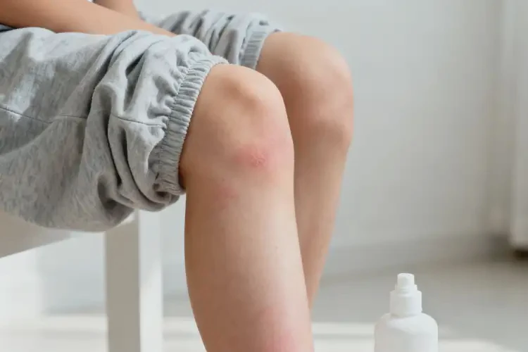 青少年大腿上起濕疹可以治好嗎(圖1)