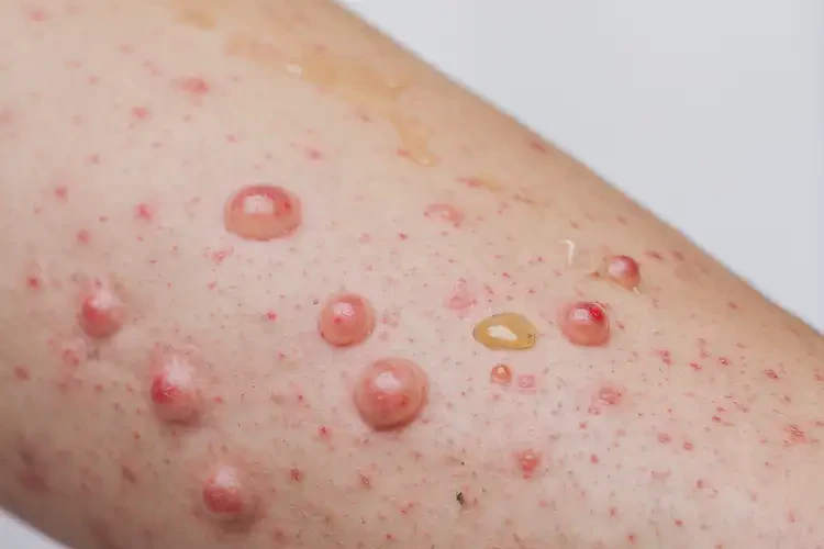 女生手臂經(jīng)常起濕疹可不可以根治(圖4)