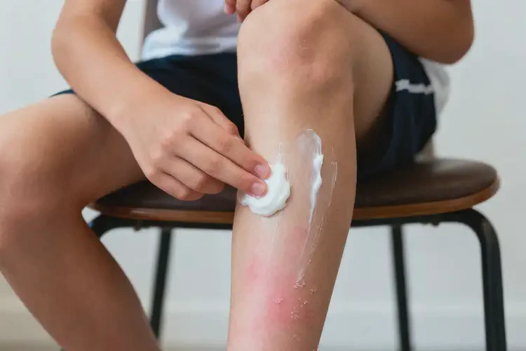 青少年小腿出現(xiàn)濕疹可不可以根治(圖4)