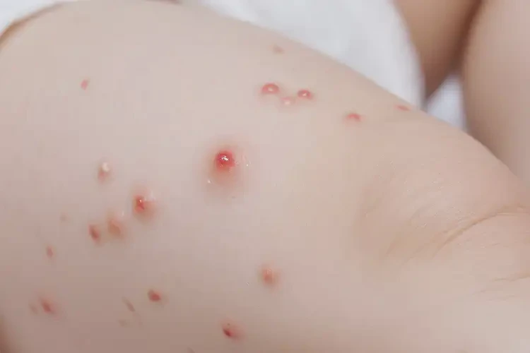 嬰幼兒小腿容易起濕疹可以治好嗎(圖4)