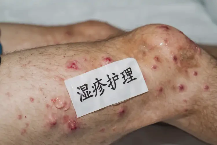 男性大腿容易長(zhǎng)濕疹可以治好嗎(圖4)