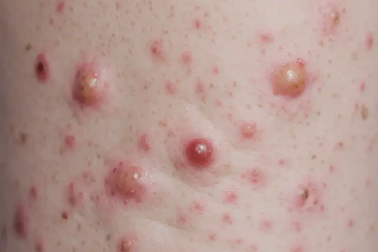 青少年屁股出濕疹可不可以根治(圖4)