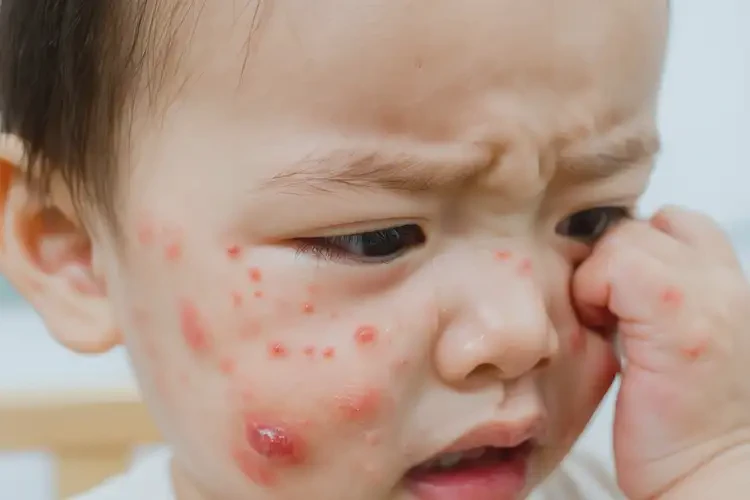 幼兒臉上容易起濕疹可不可以根治(圖4)