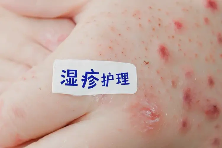 兒童手上偶爾長(zhǎng)濕疹可以治好嗎(圖4)