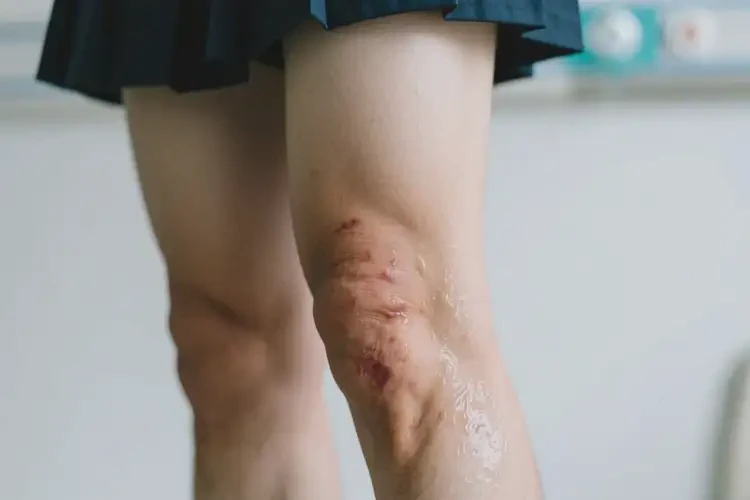 大學(xué)生大腿上出現(xiàn)濕疹可不可以根治(圖1)