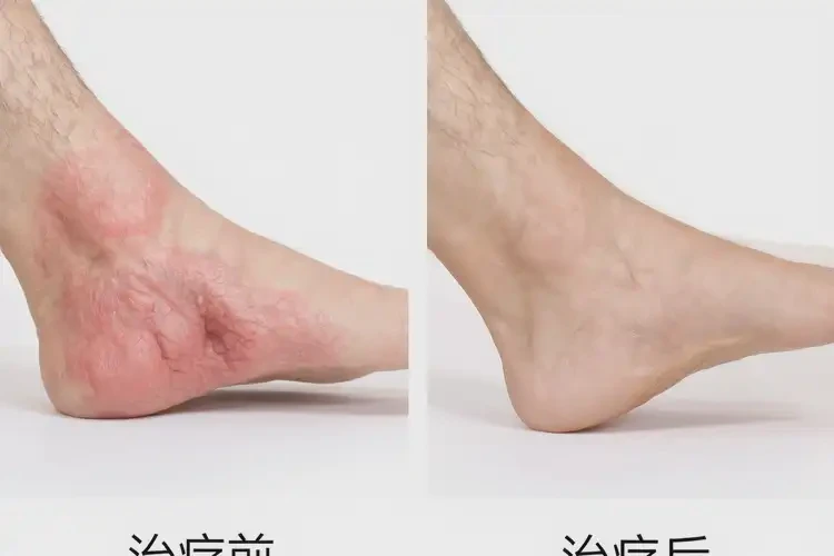 男生腳上出現(xiàn)濕疹可以治好嗎(圖4)