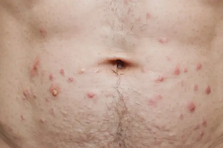 男人肚子經(jīng)常起濕疹可不可以根治(圖4)