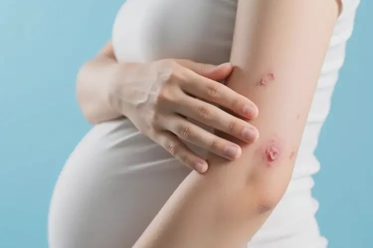 產(chǎn)婦手臂上偶爾起濕疹可以治好嗎(圖2)