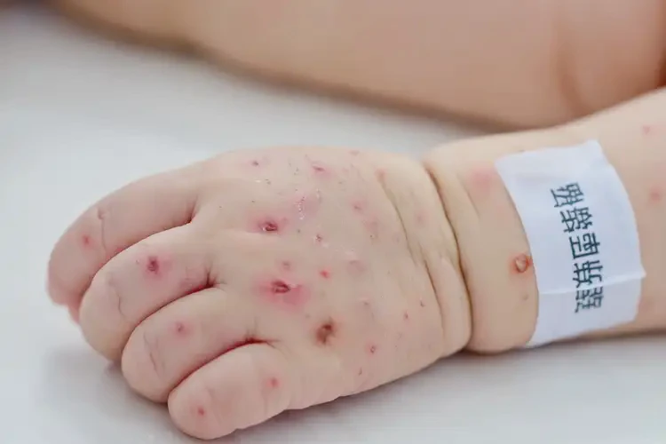 嬰兒手上出現(xiàn)濕疹可以治好嗎(圖4)
