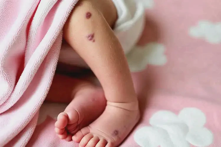 新生兒大腿上有濕疹可以治好嗎(圖1)