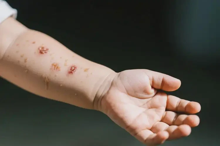 小孩手臂上偶爾起濕疹可以治好嗎(圖3)