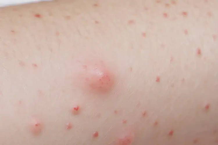 小孩肚子偶爾起濕疹可以治好嗎(圖4)