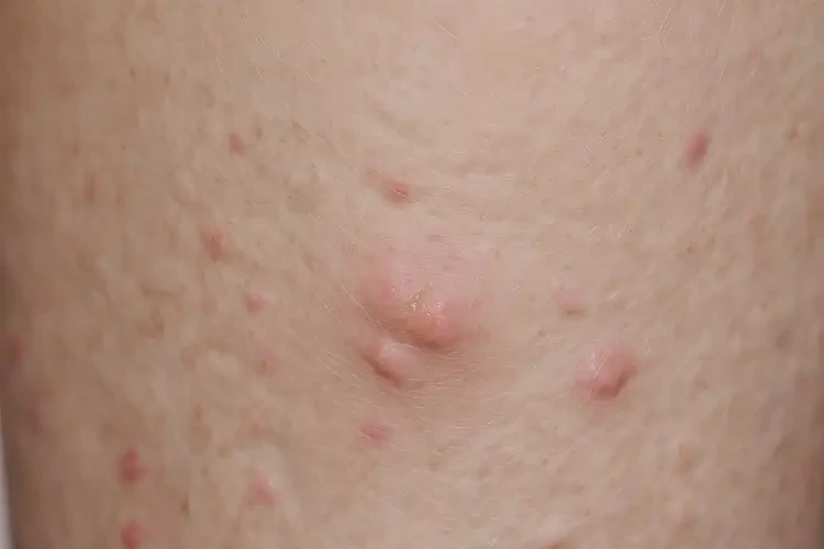 女生小腿偶爾長濕疹不管它會自己好嗎(圖4)