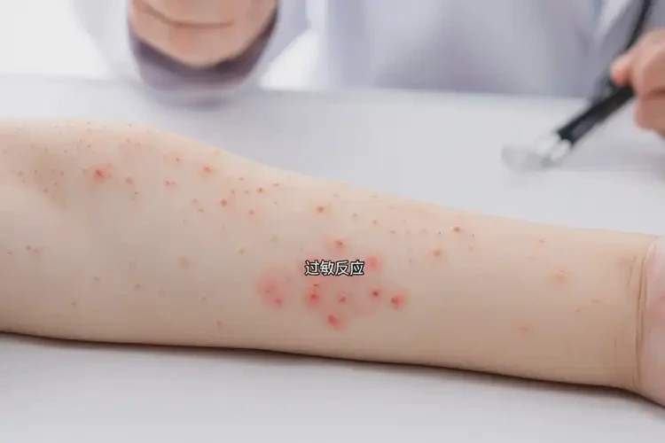 少兒全身經(jīng)常起濕疹可以治好嗎(圖4)