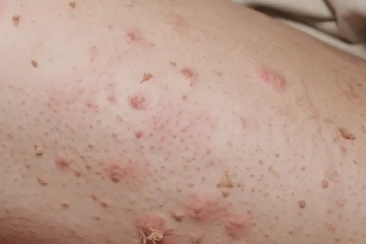 青年人大腿上經(jīng)常起濕疹可不可以根治(圖4)