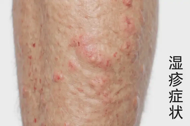 老年人小腿上出現(xiàn)濕疹可以治好嗎(圖4)