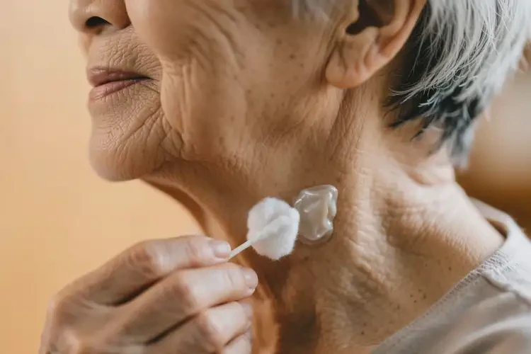 老年人脖子有湿疹可以治好吗(图2)