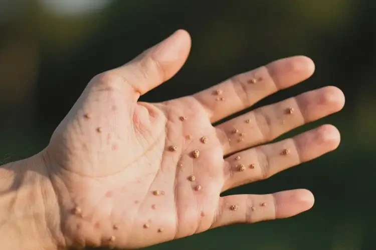 男人手上偶爾起濕疹可不可以根治(圖3)