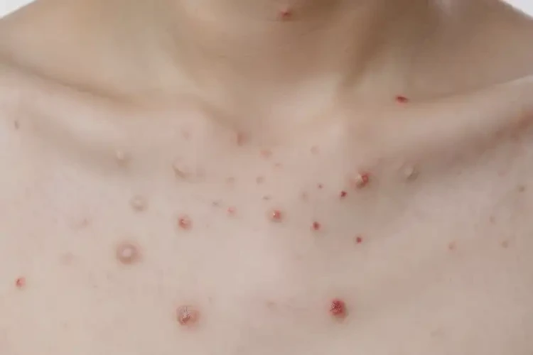 青少年脖子上出現(xiàn)濕疹可以治好嗎(圖4)