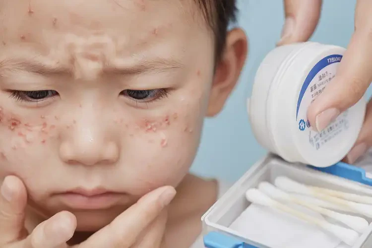 少兒臉上經(jīng)常長濕疹可以治好嗎(圖4)
