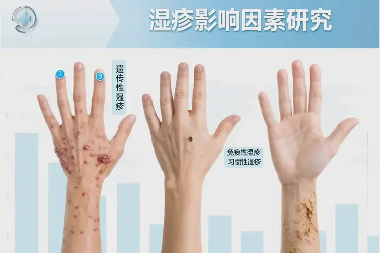 青年人手上偶爾起濕疹可不可以根治(圖3)