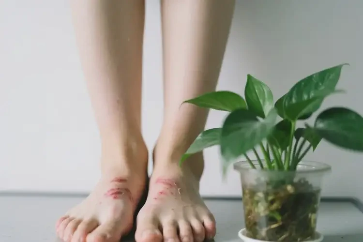 大学生脚上起湿疹可不可以根治(图4)