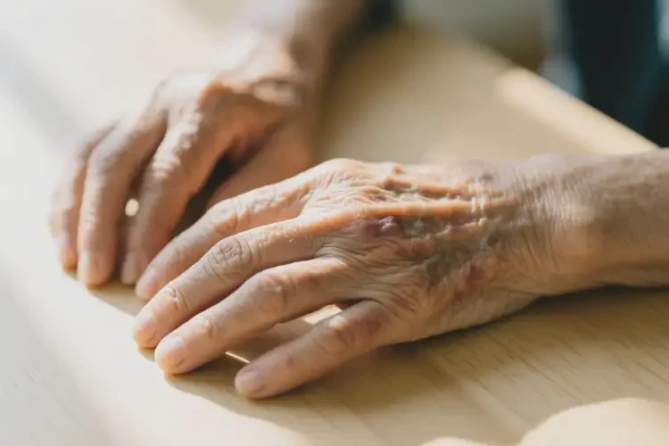 老年人手上偶爾起濕疹可以治好嗎(圖3)